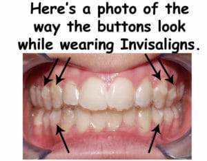 14 Things You Need To Know Before Starting Invisalign Pjn Dental