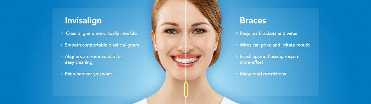 Invisalign ® First clear aligners.