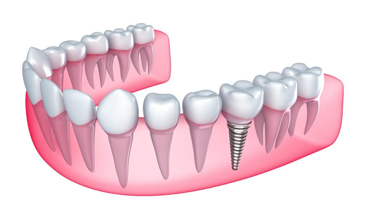 Dental Implants Illustration