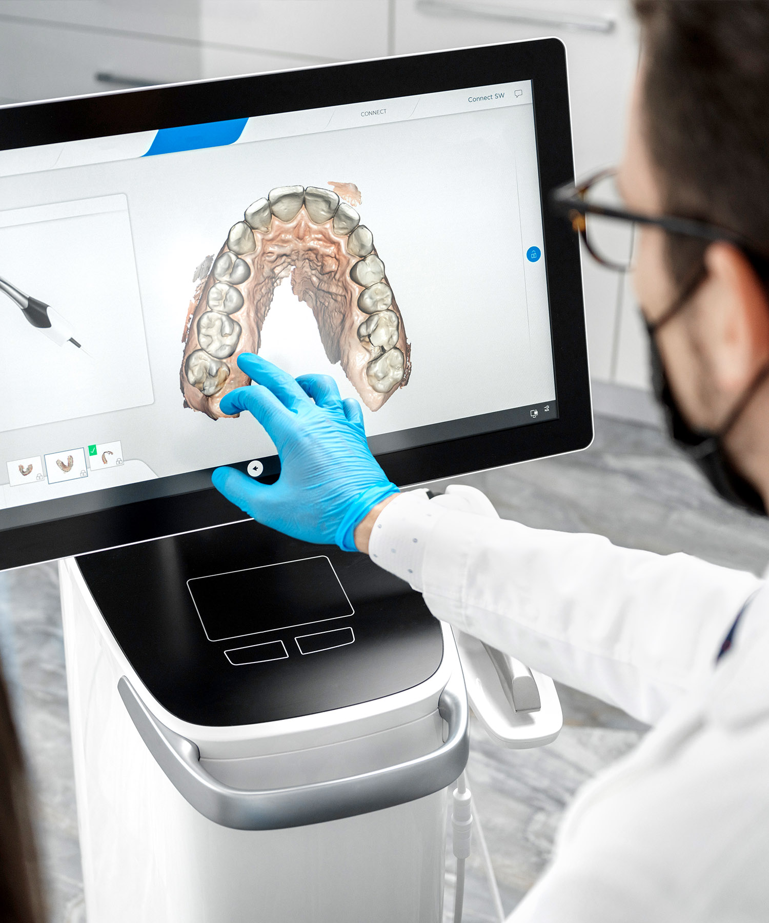A clinician analyzing a 3D intraoral scan of a patient's narrow upper dental arch to plan airway orthodontic treatment.