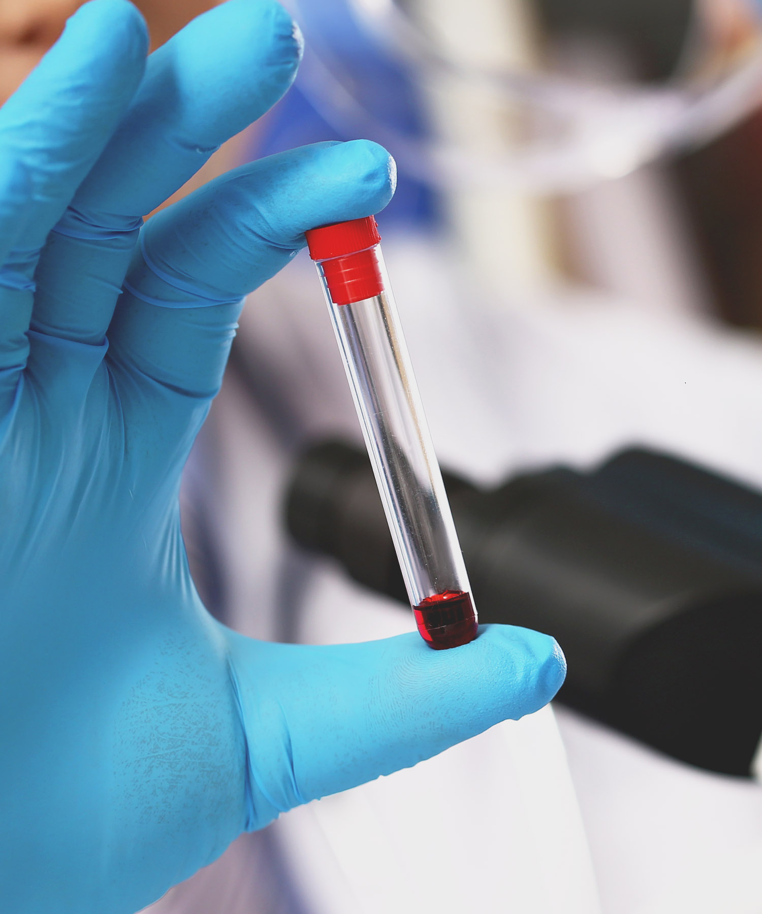 A gloved hand holds a blood sample tube for dental biocompatibility testing to screen for patient material sensitivities.