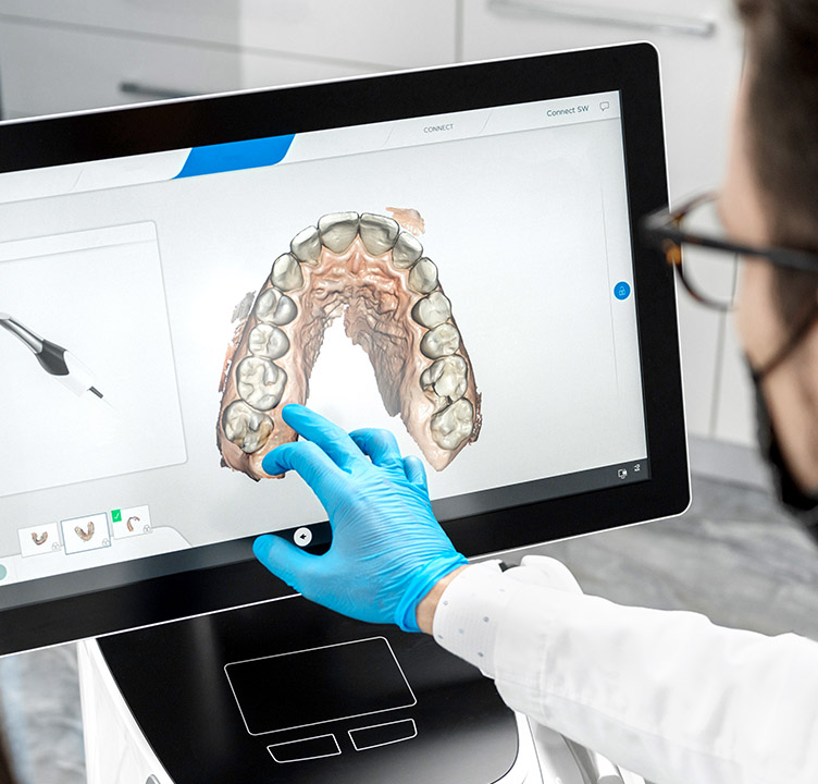A clinician analyzing a 3D intraoral scan of a patient's narrow upper dental arch to plan airway orthodontic treatment.