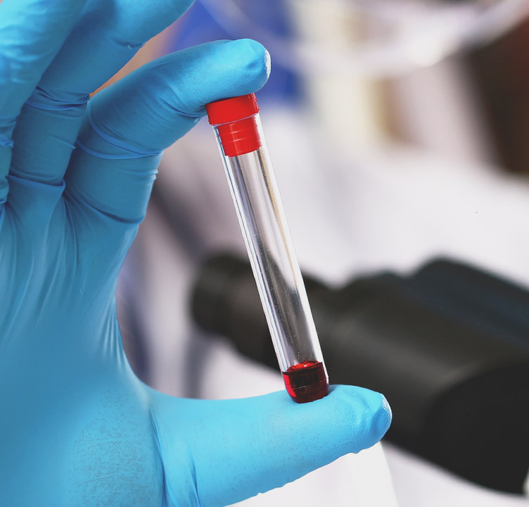A gloved hand holds a blood sample tube for dental biocompatibility testing to screen for patient material sensitivities.